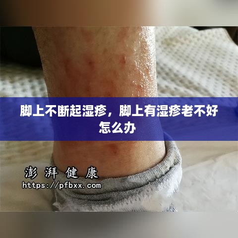 腳上不斷起濕疹，腳上有濕疹老不好怎么辦 